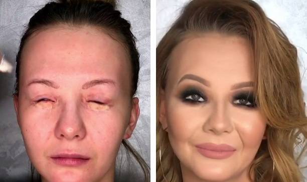 Как "избавиться" от шрамов на лице с помощью макияжа