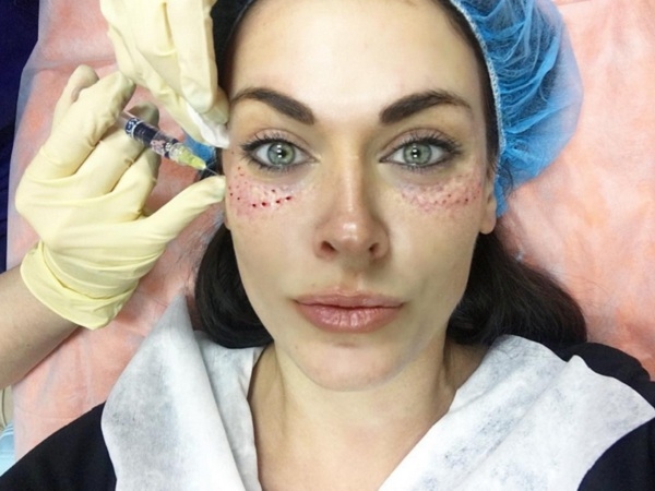 Таня Терешина шокировала снимком из клиники пластической хирургии