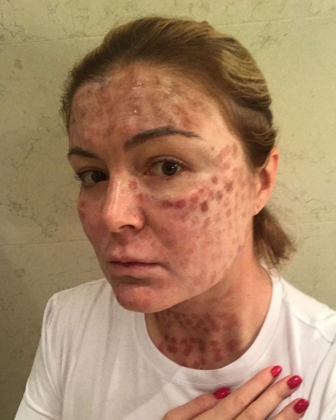 После лазерной шлифовки с лица Динары Сафиной слезла кожа