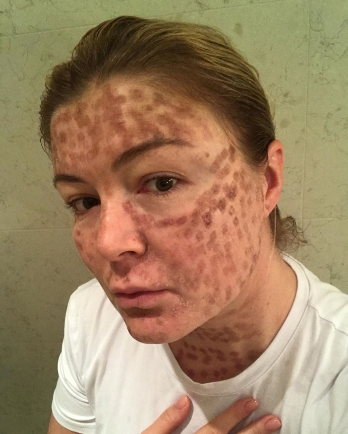 После лазерной шлифовки с лица Динары Сафиной слезла кожа