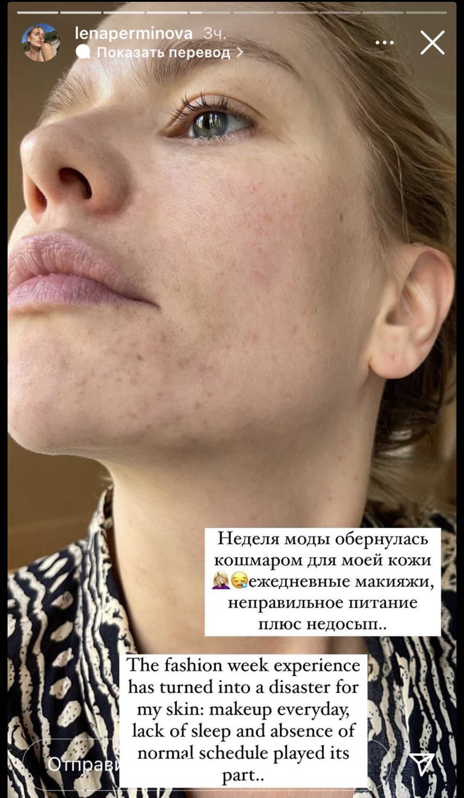 Елена Перминова показала покрывшееся сыпью лицо