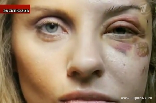 В сети появилась информация о том, что Екатерина Архарова минимум три раза получала сотрясение мозга за время брака с Маратом Башаровым