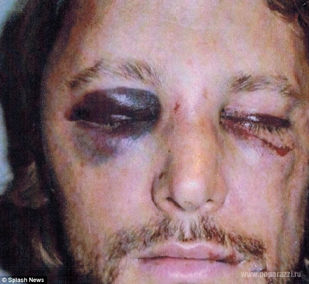 В интернете появились жуткие фото избитого экс-бойфренда Халле Берри