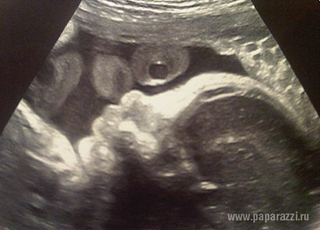 Шакира похвасталась фотографией неродившегося ребенка