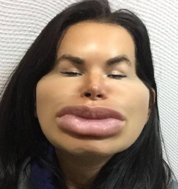 Катя Жужа ужаснула распухшим лицом и сильно увеличенными губами