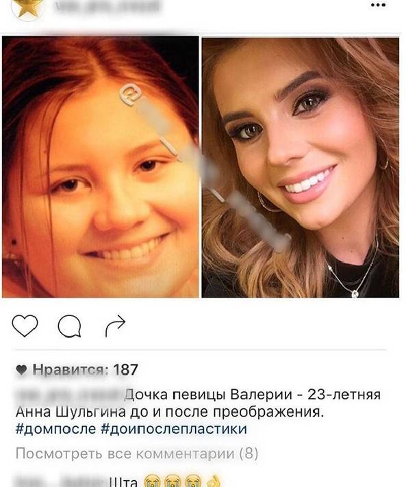 Анна Шульгина откровенно рассказала про пластику лица