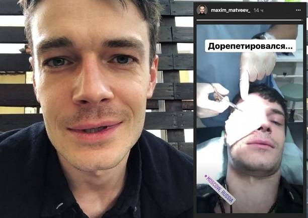 Максим Матвеев изуродовал себе лицо