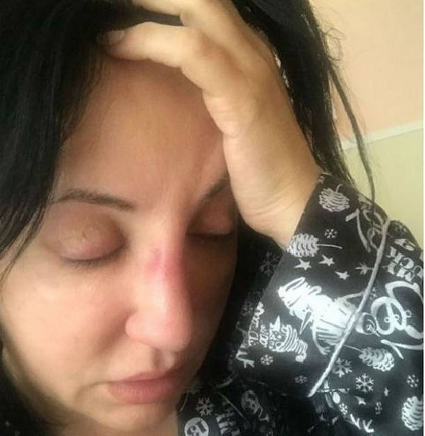 Фатима Хадуева не может прийти в себя после операции