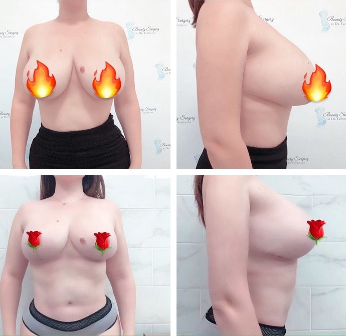 Модель Plus Size Юлия Рыбакова показала шрамы на своей новой груди