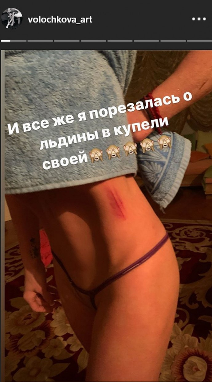 Анастасия Волочкова в микро-стрингах показала шрамы на теле