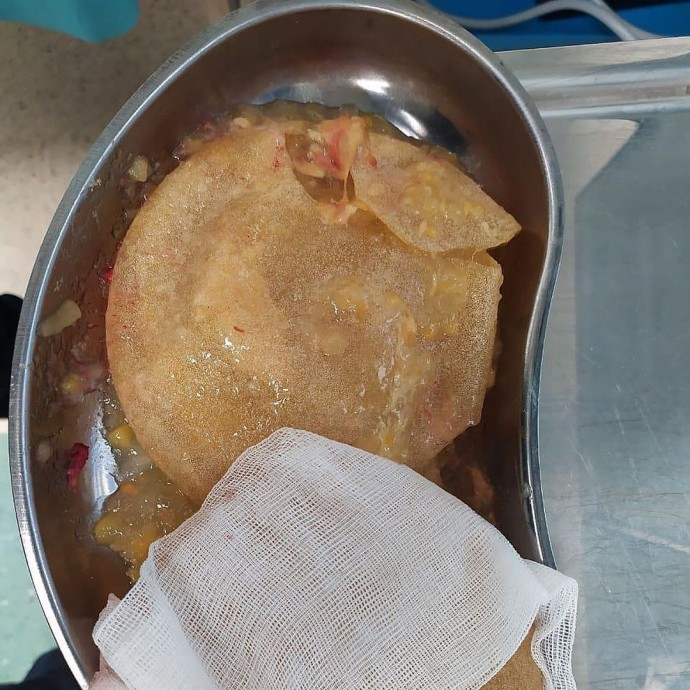 "Вычищали 4 часа": Лера Кудрявцева показала тошнотворное фото разорвавшегося импланта