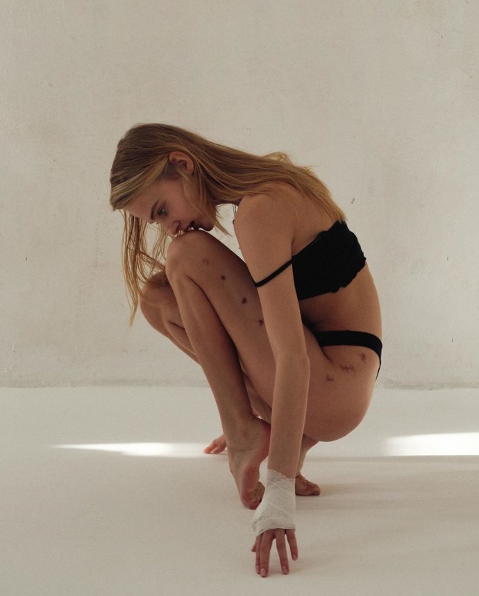 Модель Ксения Пунтус опубликовала фото со шрамами на теле