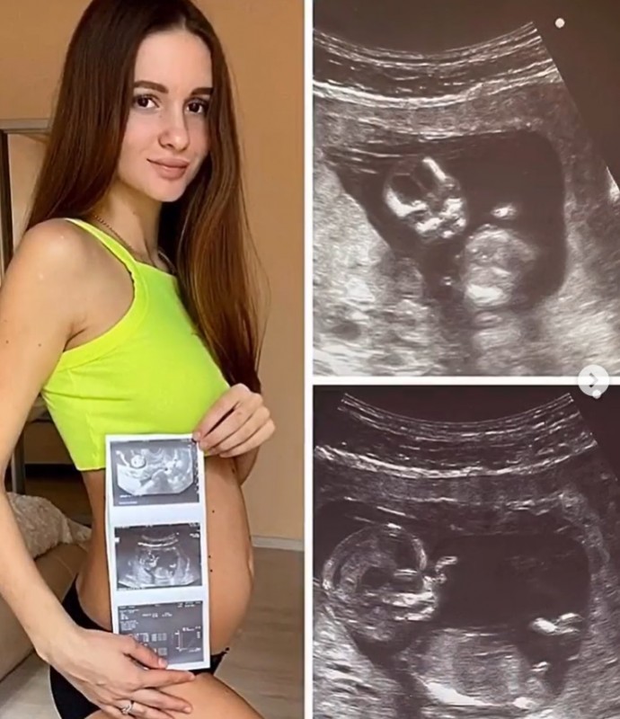 Беременная жена Андрея Чуева показала фото после лапароскопии кисты яичника