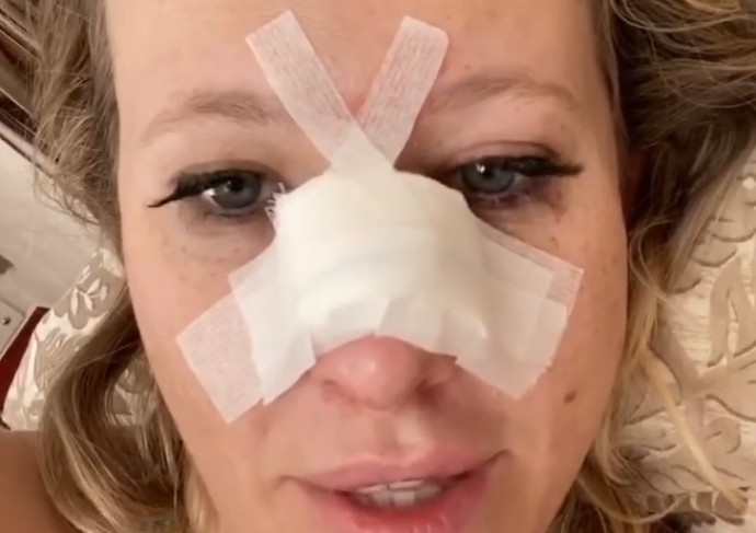 Как изменился нос Ксении Собчак после операции
