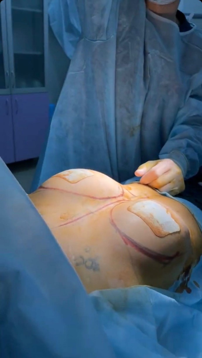 Диана Шурыгина сняла на видео медицинский осмотр своей новой груди