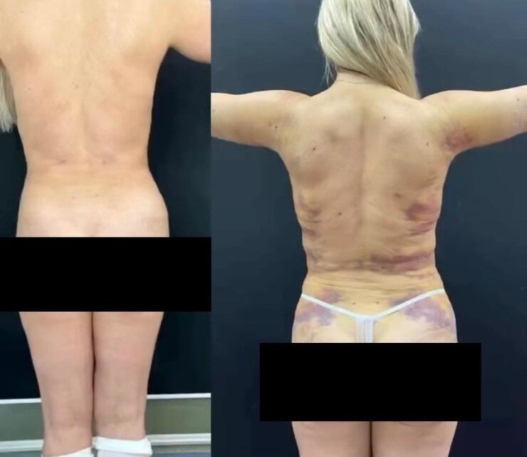 “Scary to watch”: Dana Borisova showed the result of liposuction
