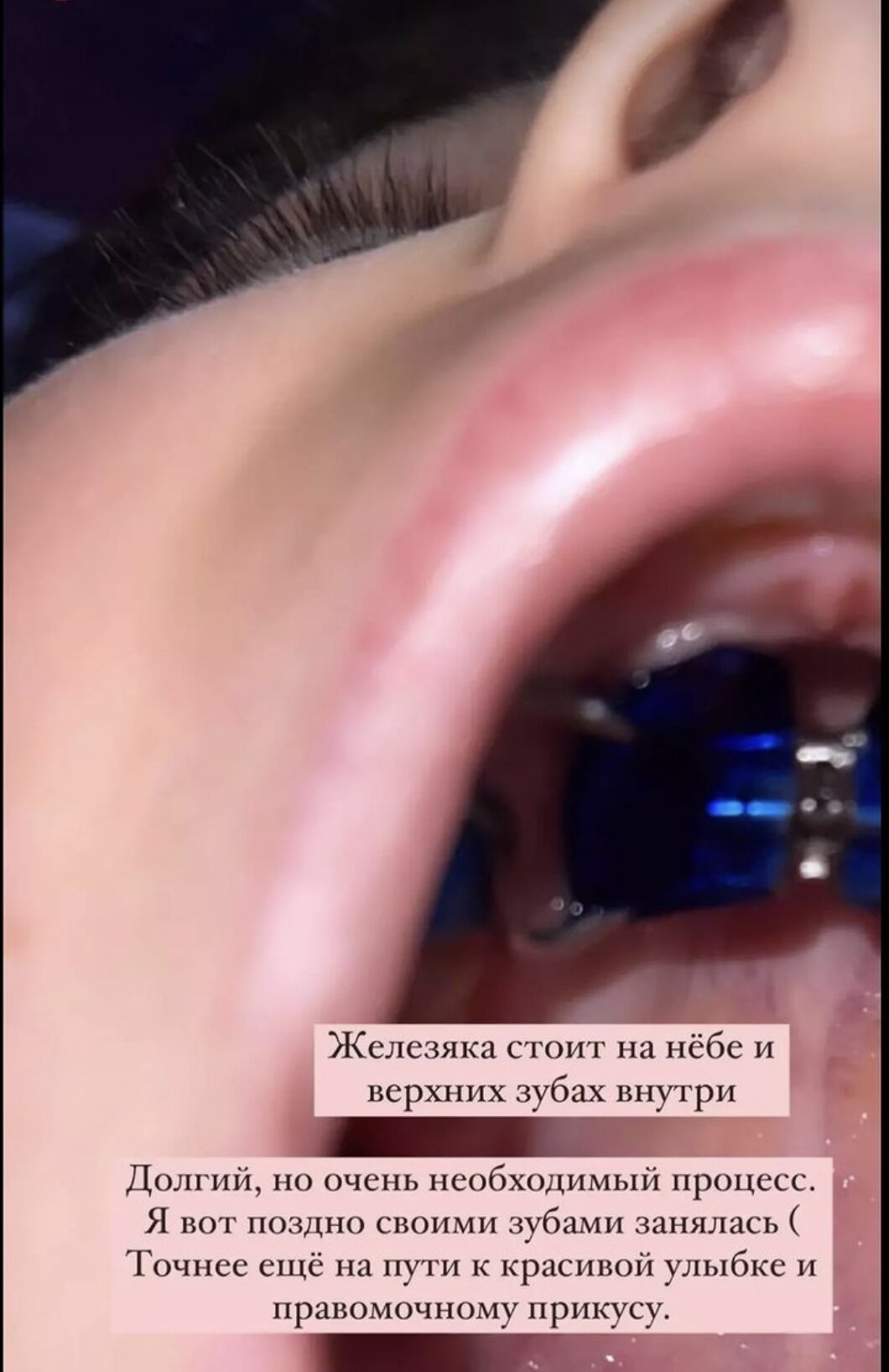 Алёна Водонаева показала содержимое своего рта и носа