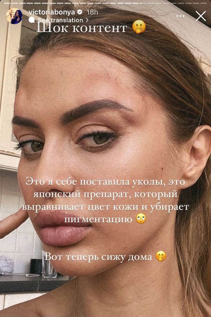 Виктория Боня изуродовала себе лицо косметическими процедурами