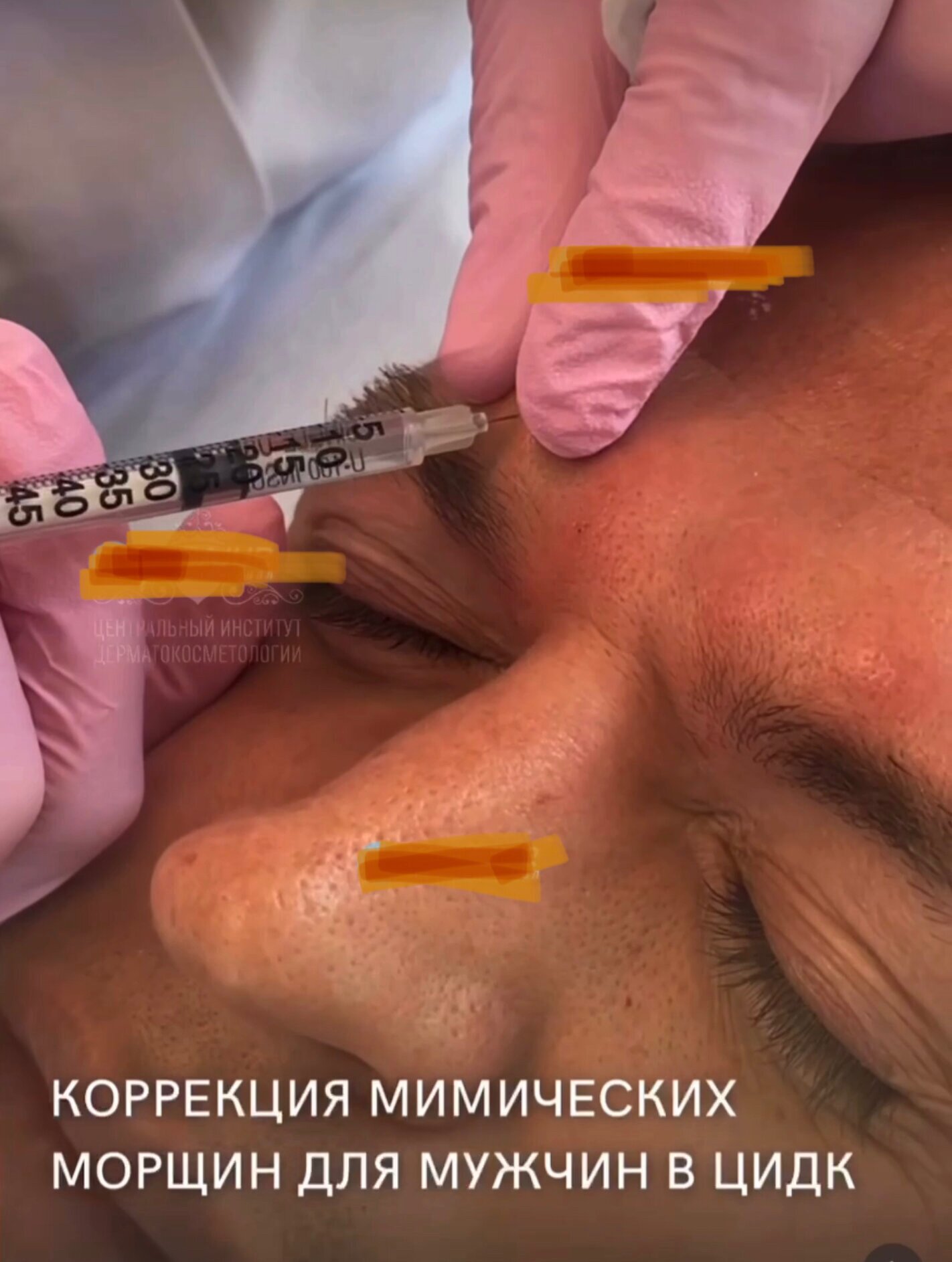 Денег нет совсем: Анастасия Костенко сделала уколы ботокса по бартеру вслед за Дмитрием Тарасовым