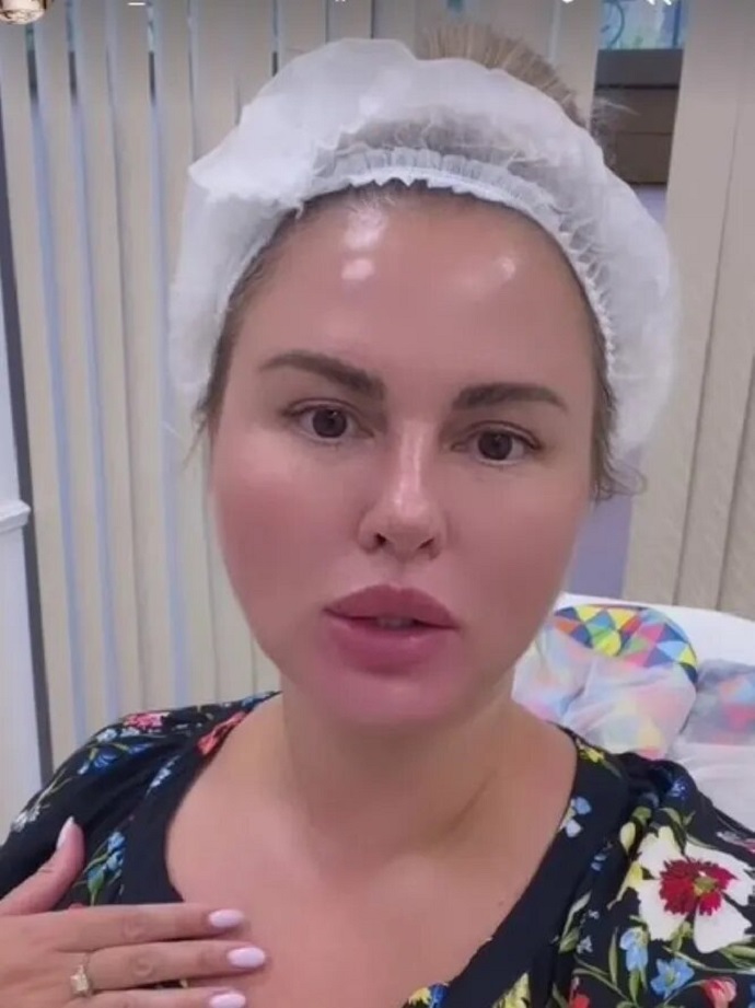 «Иду как на гильотину»: Анна Семенович показала, как с помощью уколов красоты борется с перееданием 