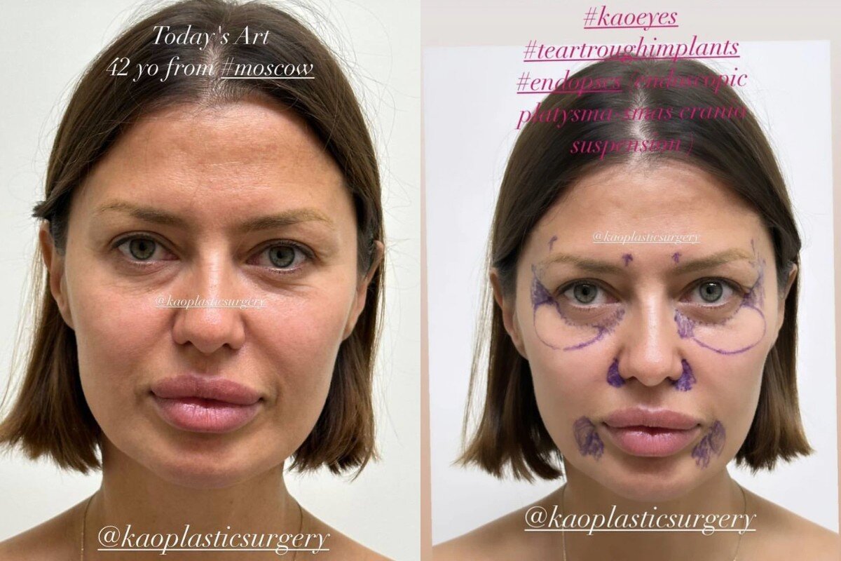 «Женщина из Казахстана»: Виктория Боня таки засветила свои многострадальные глаза после пластической операции